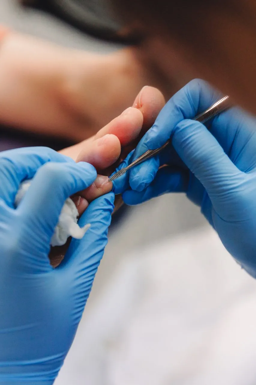 Gloved hands using a fine instrument to treat the edge of a toenail.