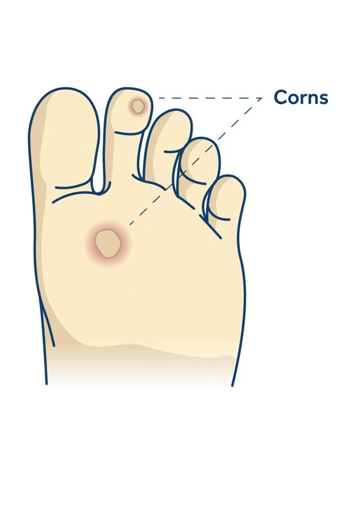 corns and callus