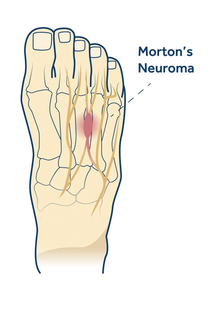 mortons neuroma